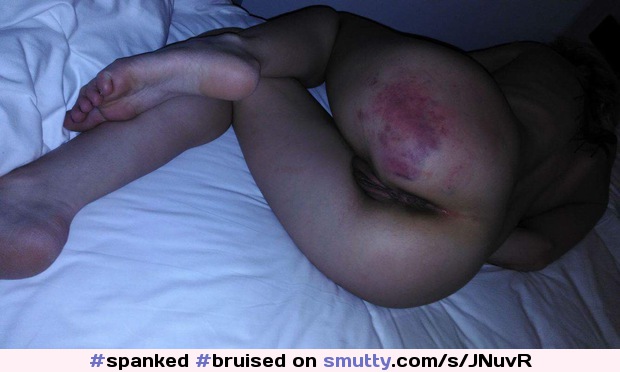 #spanked #bruised